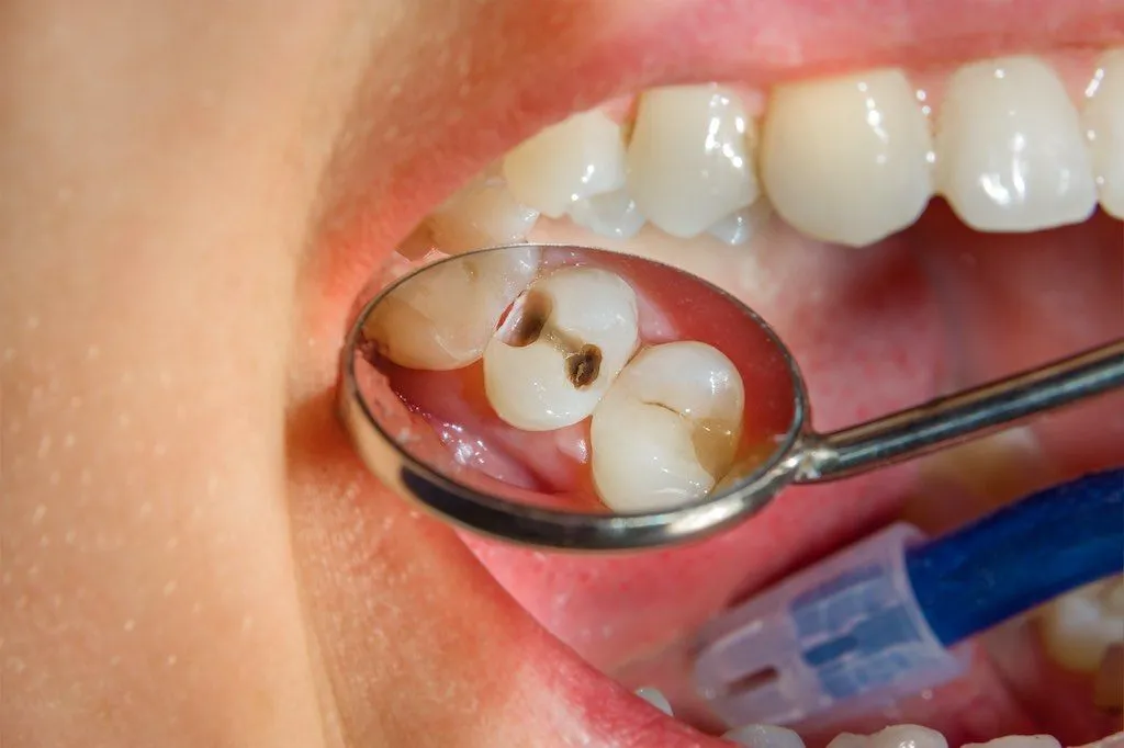 ¿Qué es una caries profunda?