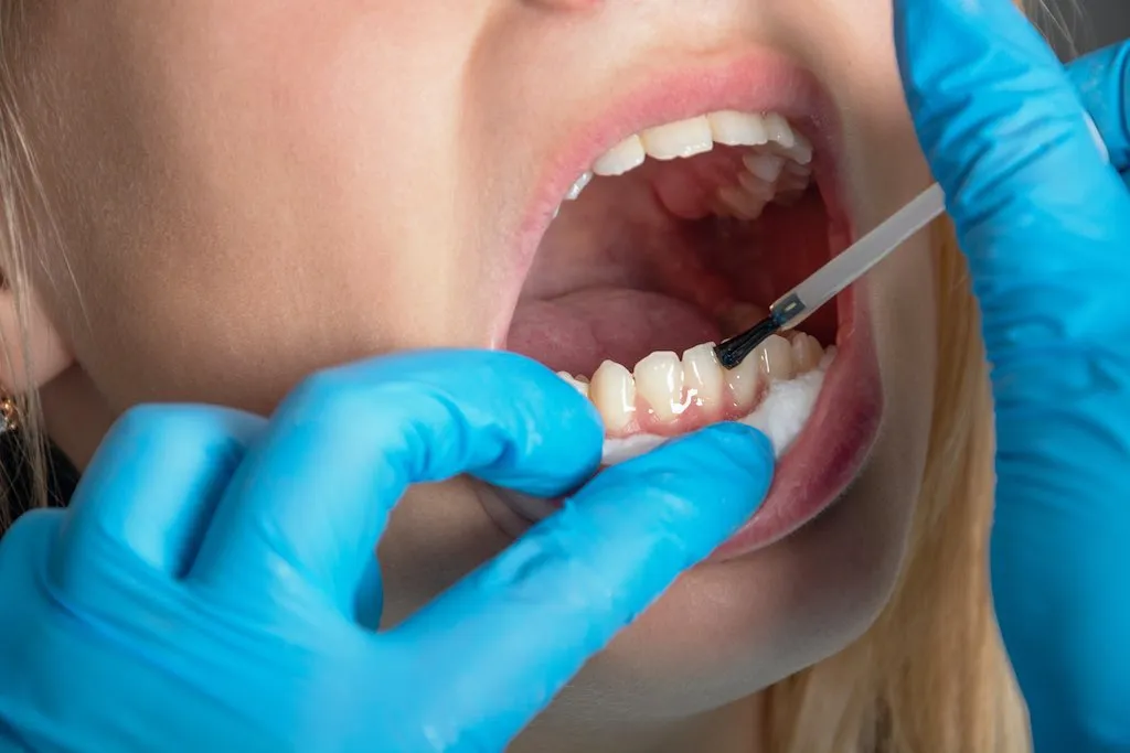 Esmalte dental: ¿qué es y cómo recuperarlo?