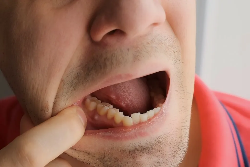 Causas y tratamientos de los abscesos dentales