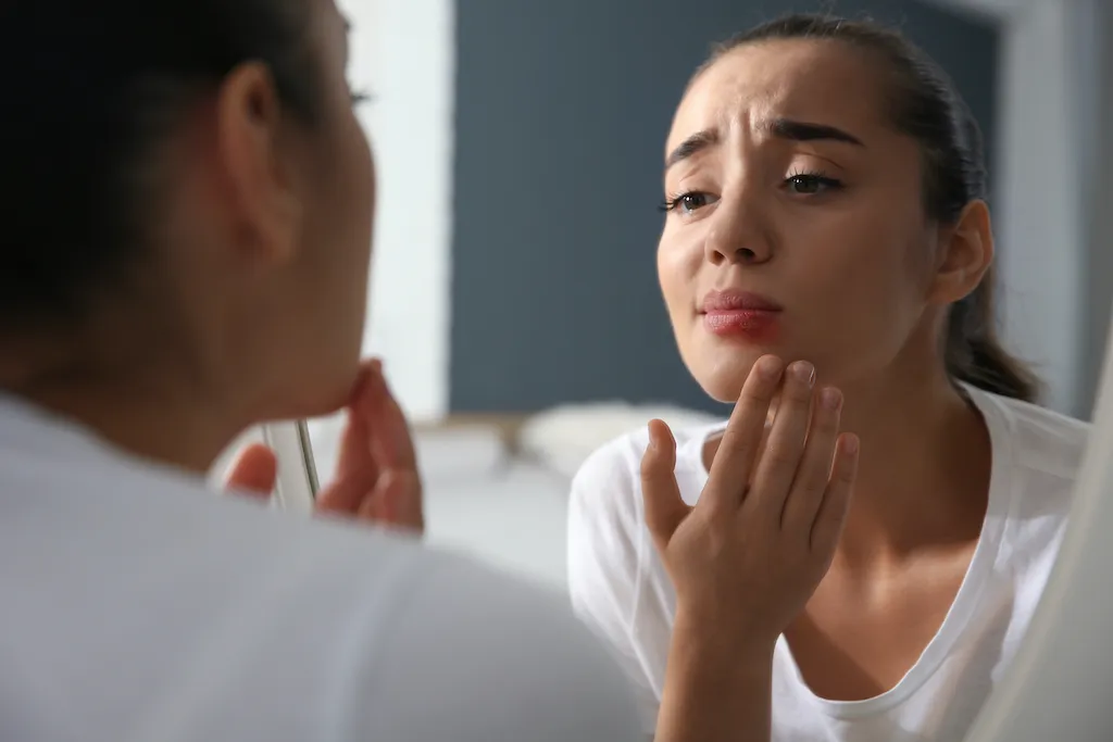 Herpes labial: ¿Qué es y por qué sale?