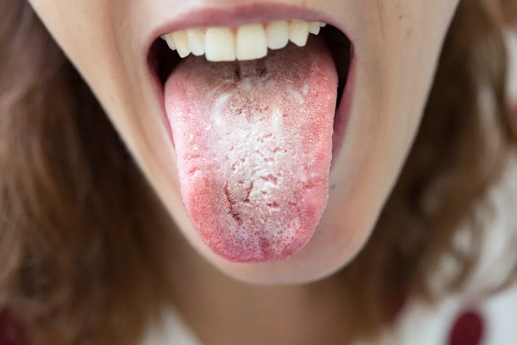 Principales causas de la lengua blanca