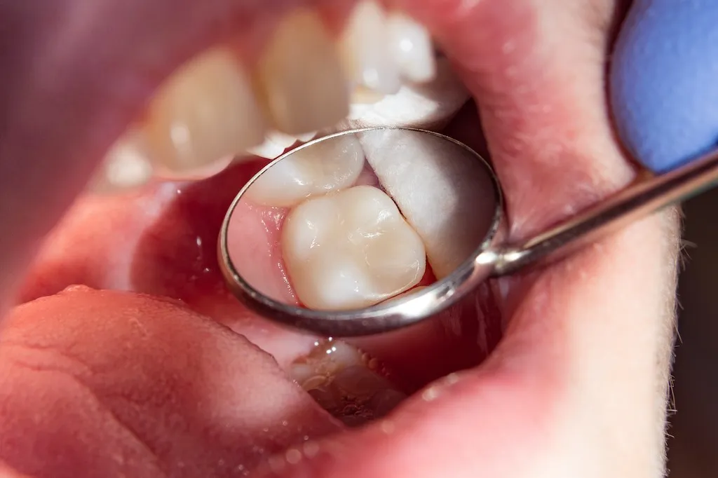 Qué son y función de los dientes molares