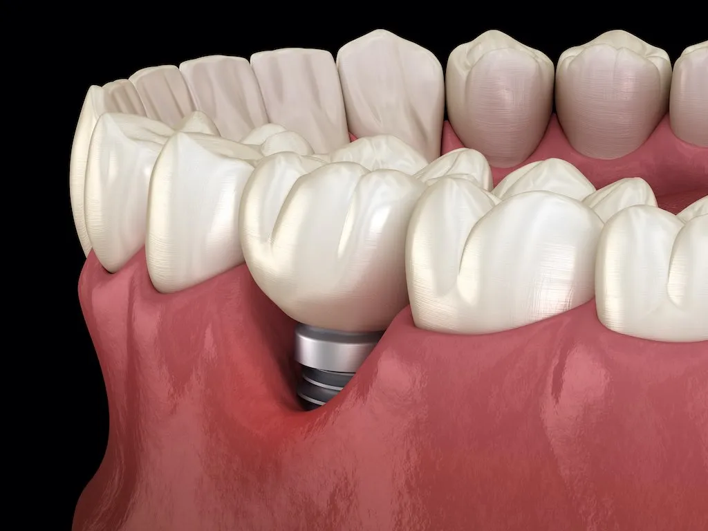 periimplantitis que es