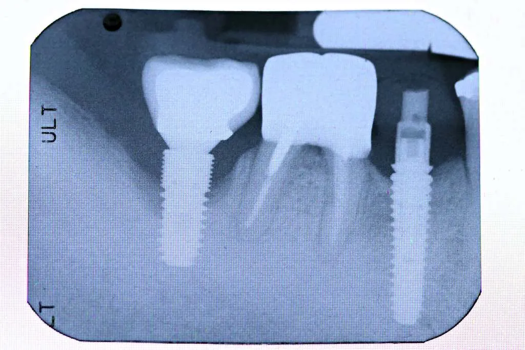 Periinplantitis: qué es y tratamiento