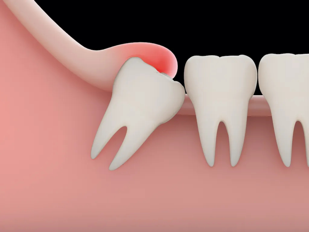 dientes incluidos