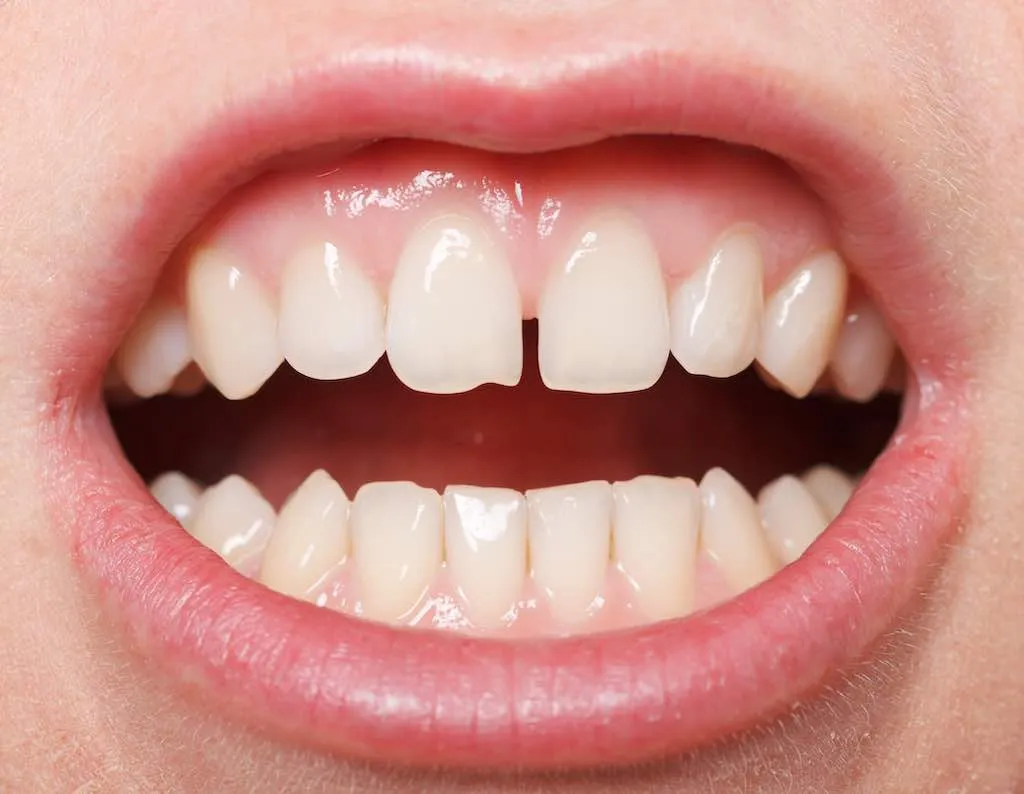 Todo sobre el diastema dental