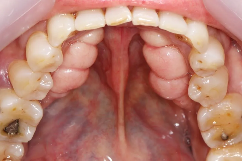 torus mandibular