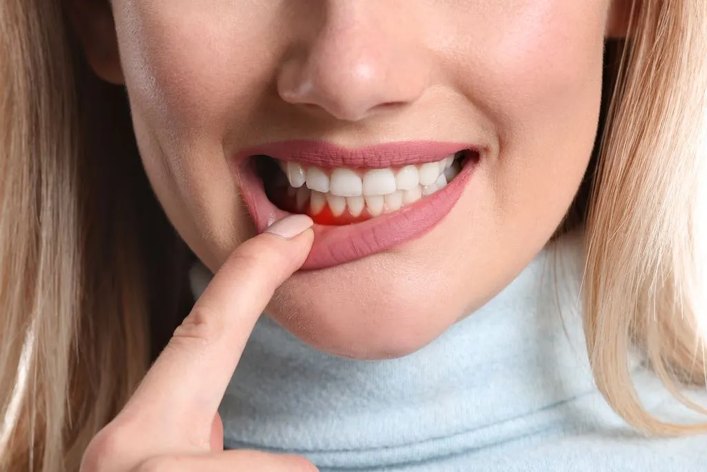 Todo lo que necesitas saber sobre la gingivitis