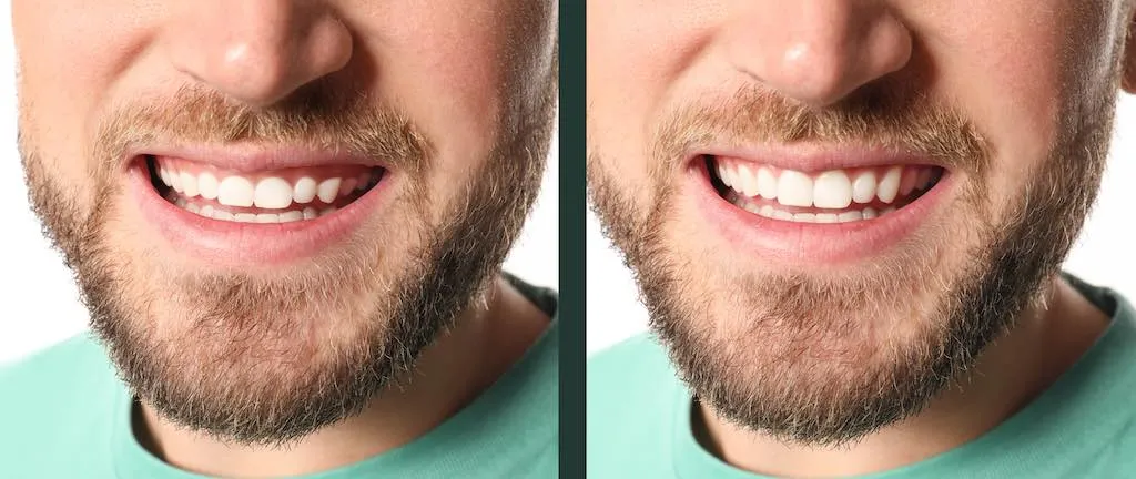 sonrisa gingival que es