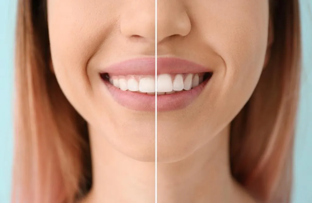 Sonrisa gingival. Causas y tratamientos