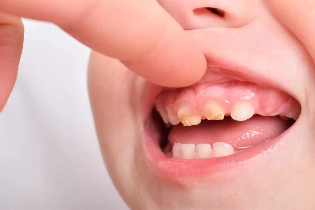 ¿Qué son las caries de biberón?