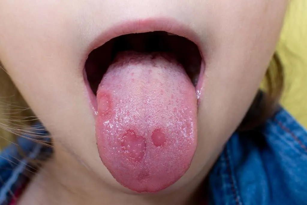 Descubre todo sobre la estomatitis