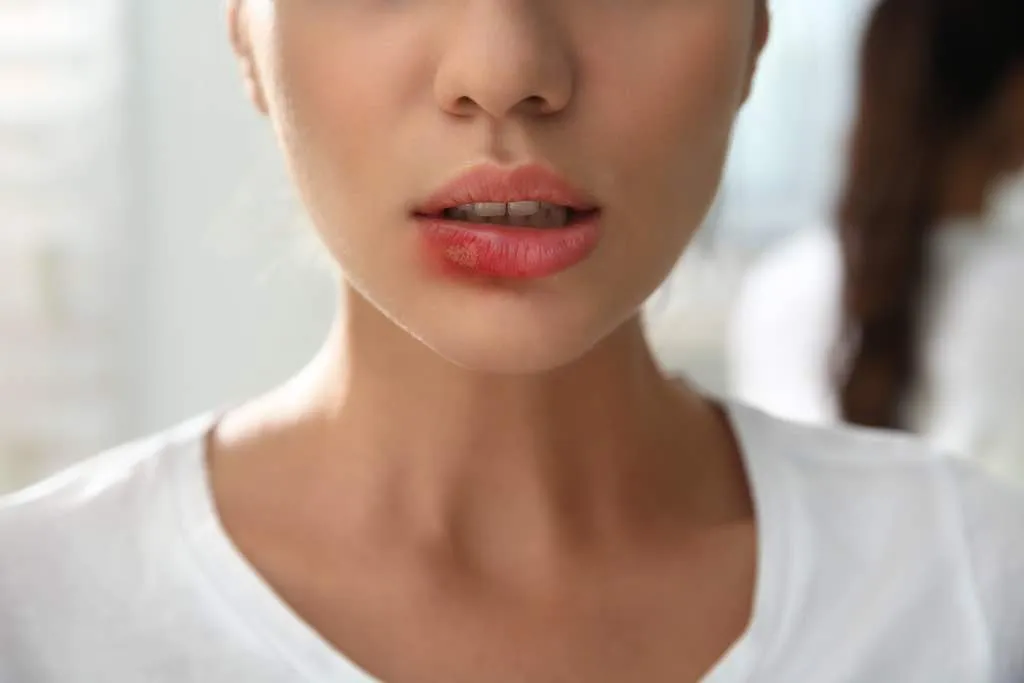 ¿Por qué salen calenturas labiales?