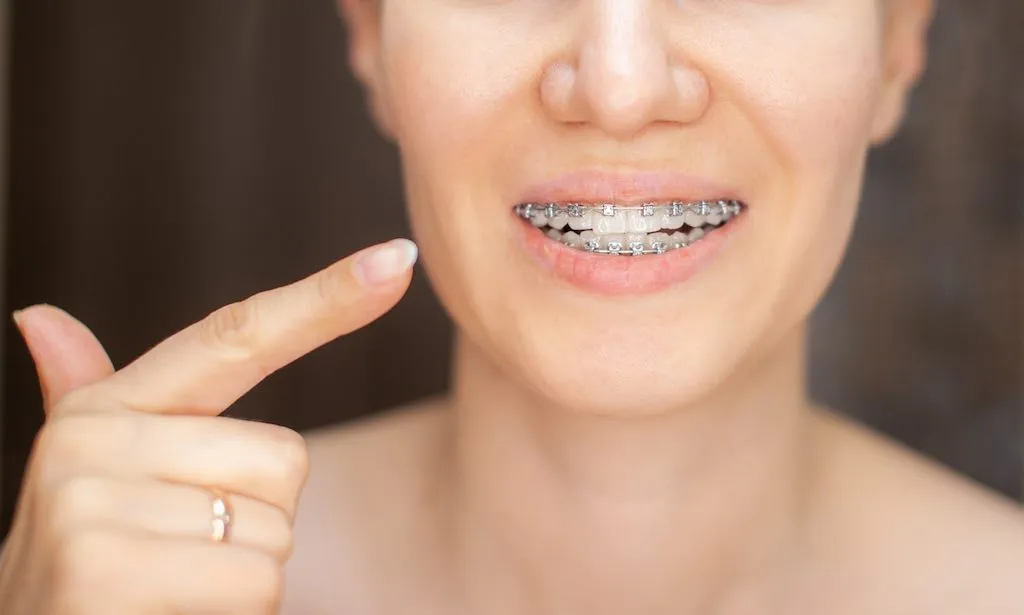dientes apiñados tratamientos