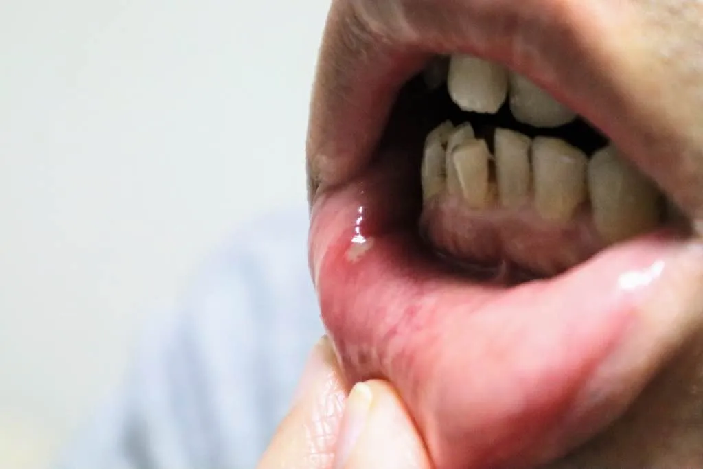 ¿Qué es la mucositis oral?
