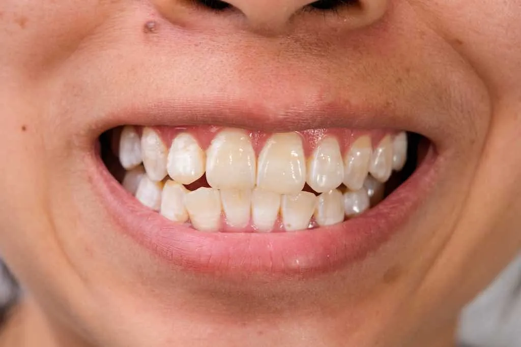Manchas blancas en los dientes: causas y tratamientos